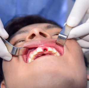 implates_dental