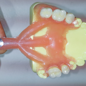 protesis_dental